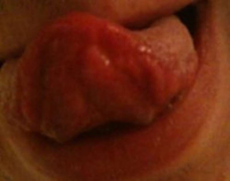 This is a granular cell tumor